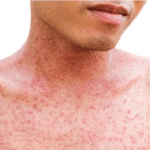 Measles Spreads Fast — Stay Safe