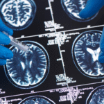 Younger Generations Less Likely to Develop Dementia