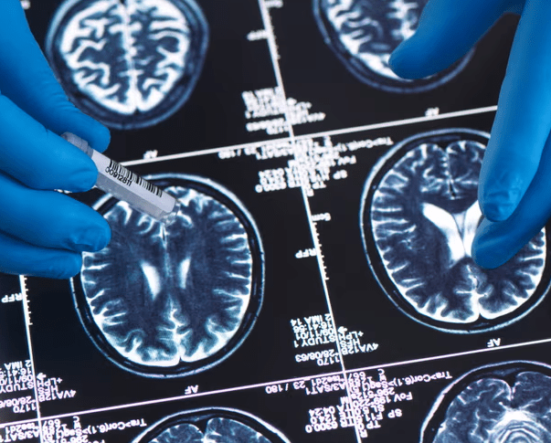 Younger Generations Less Likely to Develop Dementia